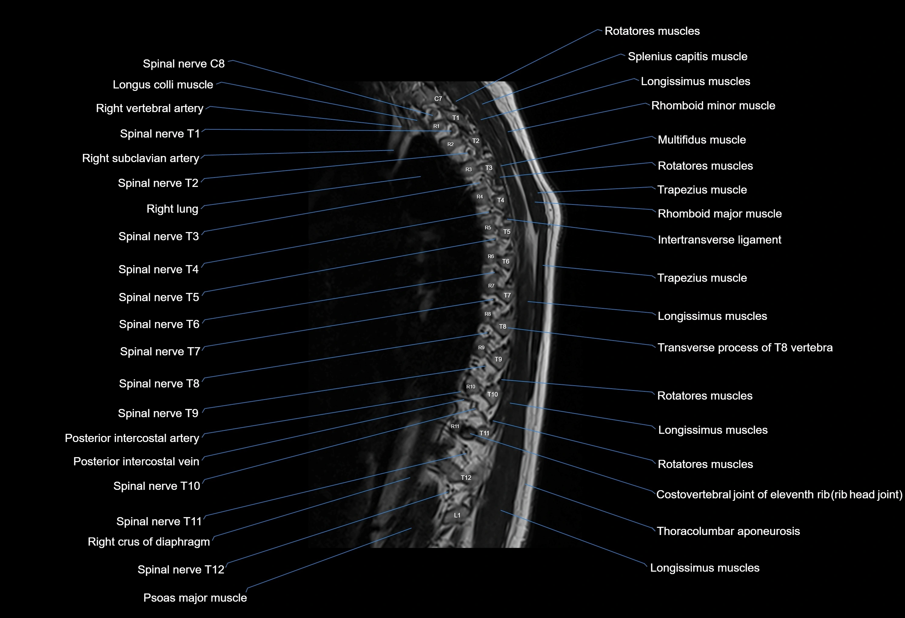 MRI thoracic spine sagittal  cross sectional anatomy 3T radiology  image-img-00001-00004.webp